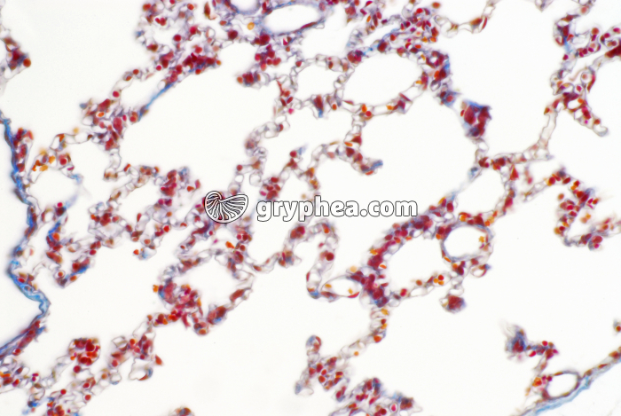 Poumon - CT montrant l'irrigation sanguine x100 - gryphea.org